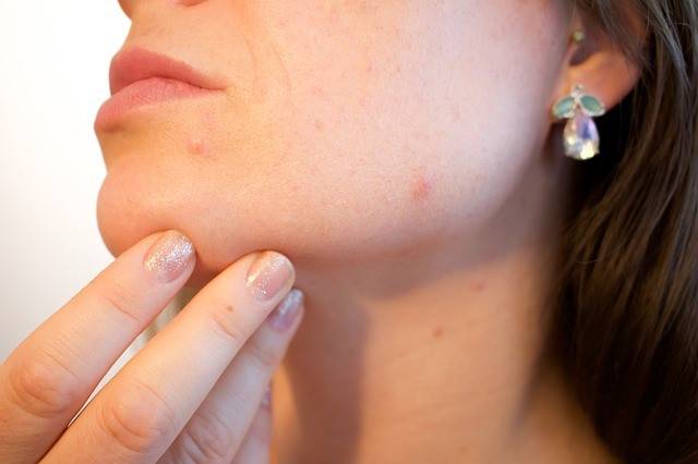 woman with spots on chin. Find remedies for pregnancy acne
