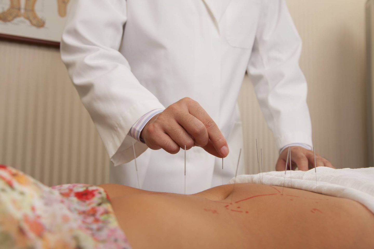 woman receiving acupuncture